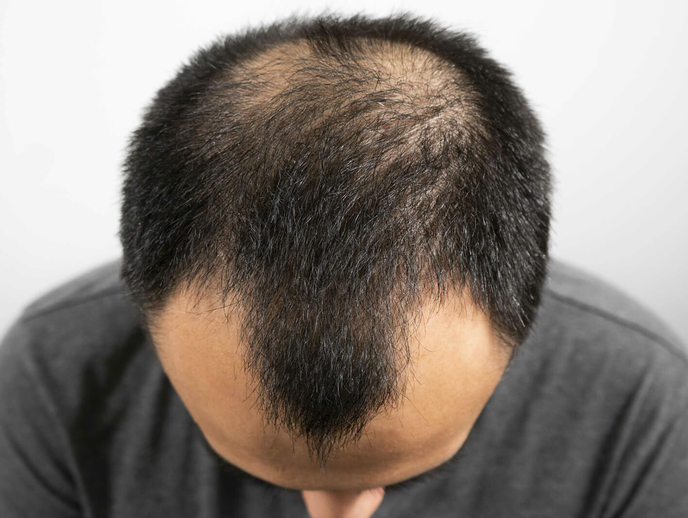 Alopecia treatment results at ryan